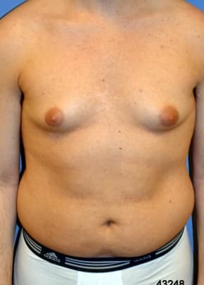 Male Breast Reduction Before & After Photos | Associates in Plastic Surgery