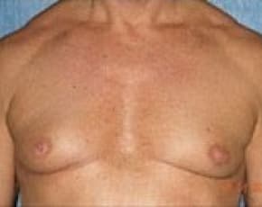 Male Breast Reduction Before & After Photos | Associates in Plastic Surgery