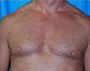Male Breast Reduction Before & After Photos | Associates in Plastic Surgery