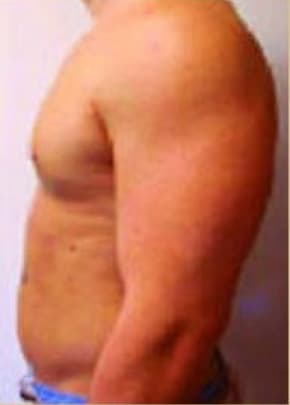 Male Breast Reduction Before & After Photos | Associates in Plastic Surgery