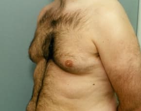 Male Breast Reduction Before & After Photos | Associates in Plastic Surgery