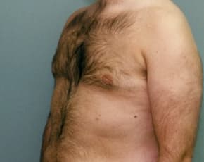 Male Breast Reduction Before & After Photos | Associates in Plastic Surgery
