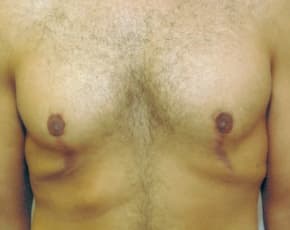 Male Breast Reduction Before & After Photos | Associates in Plastic Surgery