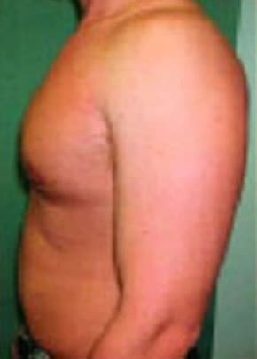 Male Breast Reduction Before & After Photos | Associates in Plastic Surgery