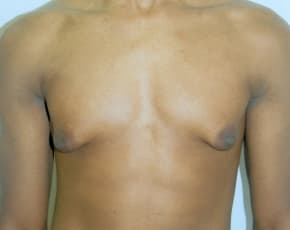 Male Breast Reduction Before & After Photos | Associates in Plastic Surgery