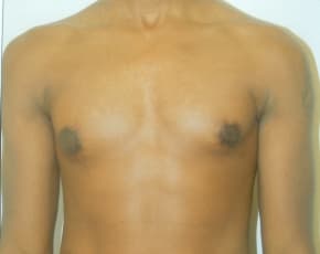 Male Breast Reduction Before & After Photos | Associates in Plastic Surgery