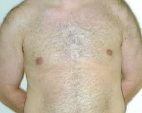 Male Breast Reduction Before & After Photos | Associates in Plastic Surgery