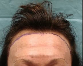    Before & After Photos | Associates in Plastic Surgery