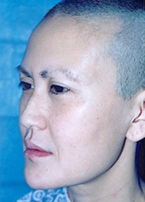 Cheeklift Threadlift Before & After Photos | Associates in Plastic Surgery