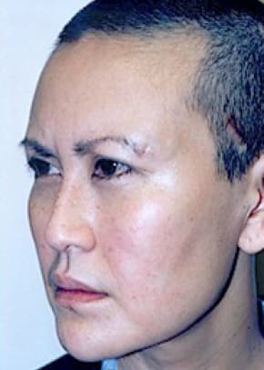 Cheeklift Threadlift Before & After Photos | Associates in Plastic Surgery