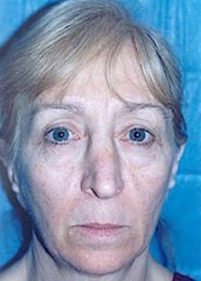 Cheeklift Threadlift Before & After Photos | Associates in Plastic Surgery