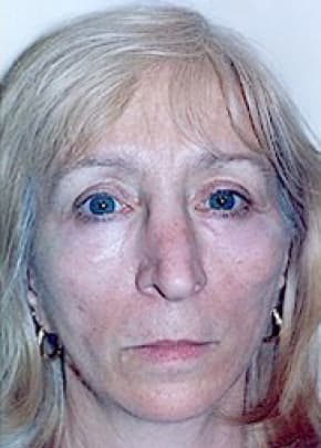 Cheeklift Threadlift Before & After Photos | Associates in Plastic Surgery