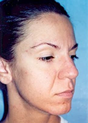 Cheeklift Threadlift Before & After Photos | Associates in Plastic Surgery