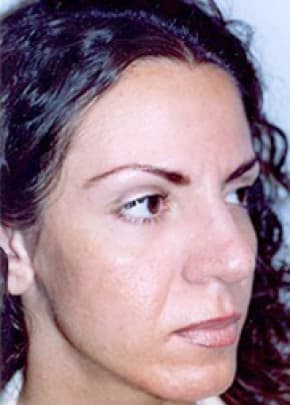 Cheeklift Threadlift Before & After Photos | Associates in Plastic Surgery