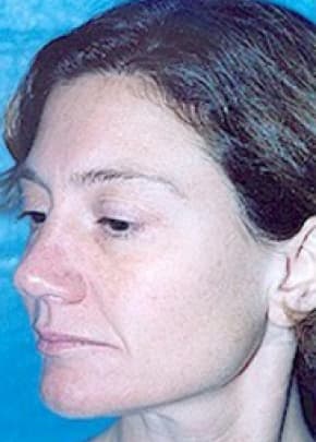 Cheeklift Threadlift Before & After Photos | Associates in Plastic Surgery
