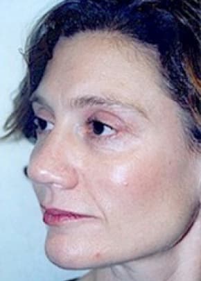 Cheeklift Threadlift Before & After Photos | Associates in Plastic Surgery