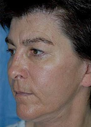 Cheeklift Threadlift Before & After Photos | Associates in Plastic Surgery