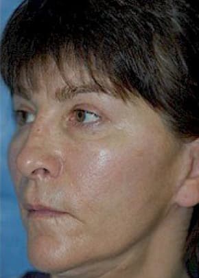 Cheeklift Threadlift Before & After Photos | Associates in Plastic Surgery