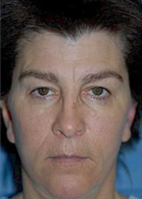 Cheeklift Threadlift Before & After Photos | Associates in Plastic Surgery