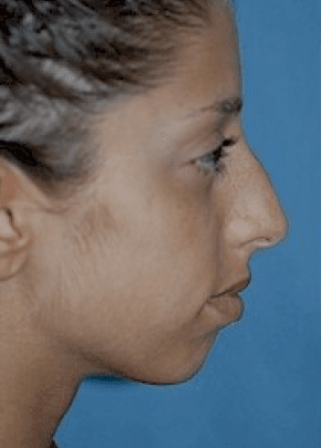 Chin And Cheek Implants Before & After Photos | Associates in Plastic Surgery