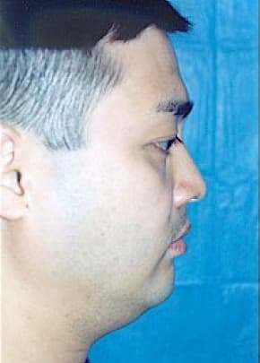 Chin And Cheek Implants Before & After Photos | Associates in Plastic Surgery