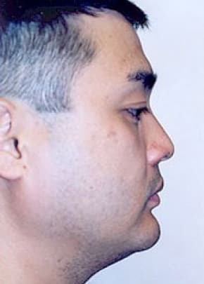 Chin And Cheek Implants Before & After Photos | Associates in Plastic Surgery