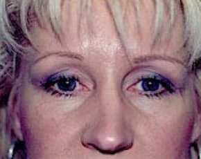 Eyelid Surgery Browlift Before & After Photos | Associates in Plastic Surgery