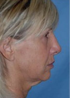 Facelift And Mini Facelift Before & After Photos | Associates in Plastic Surgery