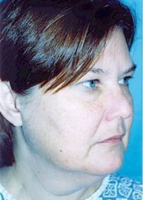 Facelift And Mini Facelift Before & After Photos | Associates in Plastic Surgery