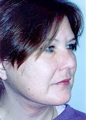 Facelift And Mini Facelift Before & After Photos | Associates in Plastic Surgery
