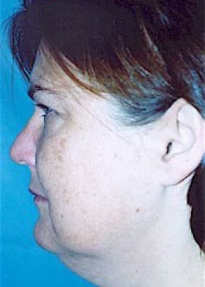 Facelift And Mini Facelift Before & After Photos | Associates in Plastic Surgery