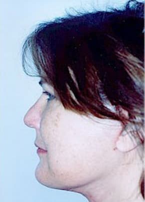 Facelift And Mini Facelift Before & After Photos | Associates in Plastic Surgery