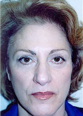 Facelift And Mini Facelift Before & After Photos | Associates in Plastic Surgery