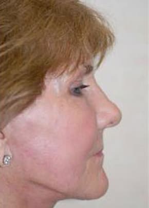 Facelift And Mini Facelift Before & After Photos | Associates in Plastic Surgery
