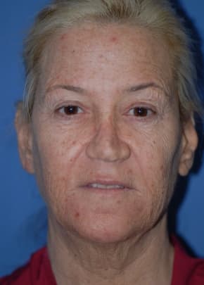 Facelift And Mini Facelift Before & After Photos | Associates in Plastic Surgery
