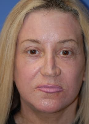 Facelift And Mini Facelift Before & After Photos | Associates in Plastic Surgery