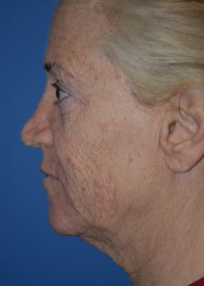 Facelift And Mini Facelift Before & After Photos | Associates in Plastic Surgery