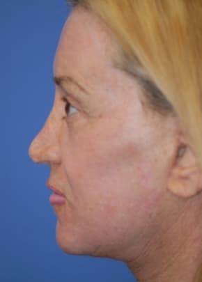 Facelift And Mini Facelift Before & After Photos | Associates in Plastic Surgery