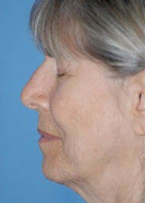 Facelift And Mini Facelift Before & After Photos | Associates in Plastic Surgery