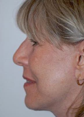 Facelift And Mini Facelift Before & After Photos | Associates in Plastic Surgery
