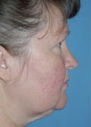 Facelift And Mini Facelift Before & After Photos | Associates in Plastic Surgery