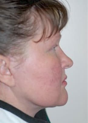 Facelift And Mini Facelift Before & After Photos | Associates in Plastic Surgery