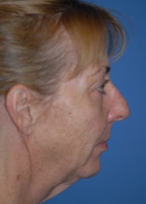 Facelift And Mini Facelift Before & After Photos | Associates in Plastic Surgery