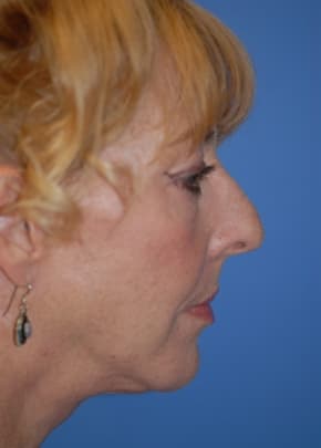 Facelift And Mini Facelift Before & After Photos | Associates in Plastic Surgery