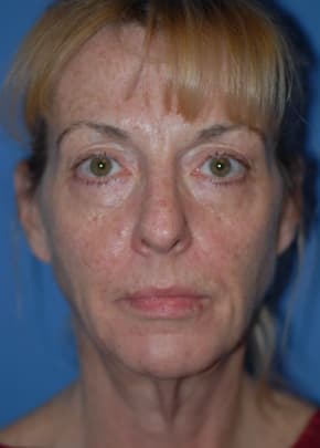 Facelift And Mini Facelift Before & After Photos | Associates in Plastic Surgery