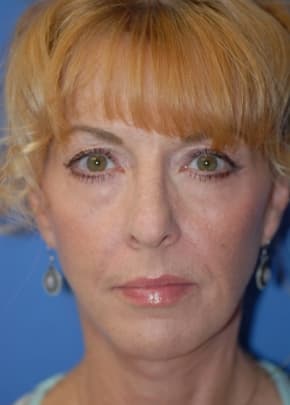 Facelift And Mini Facelift Before & After Photos | Associates in Plastic Surgery