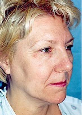 Facelift And Mini Facelift Before & After Photos | Associates in Plastic Surgery