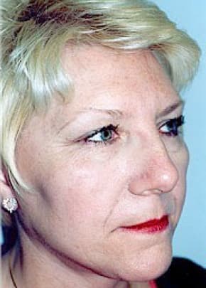 Facelift And Mini Facelift Before & After Photos | Associates in Plastic Surgery