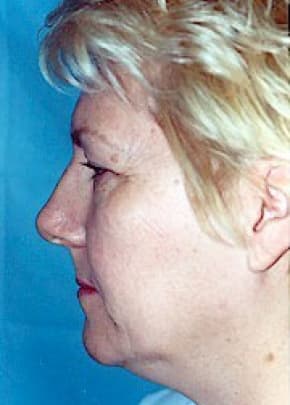 Facelift And Mini Facelift Before & After Photos | Associates in Plastic Surgery