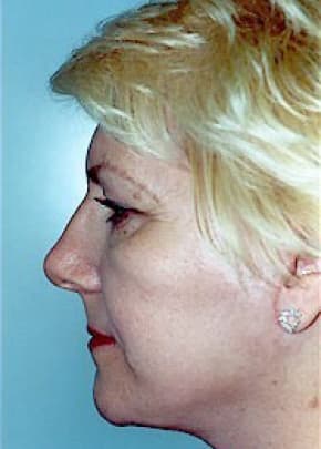 Facelift And Mini Facelift Before & After Photos | Associates in Plastic Surgery